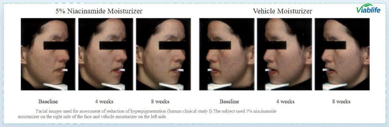 Nicotinamide for Skin Brightening